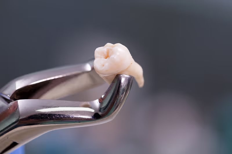 Need a Tooth Pulled? Here’s What to Expect & How to Prepare